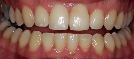 After Invisalign Treatment Smile Rooms Glasgow