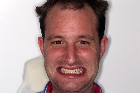 After Invisalign Treatment Smile Rooms Glasgow