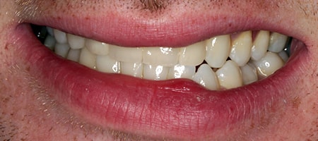 After Invisalign Treatment Smile Rooms Glasgow