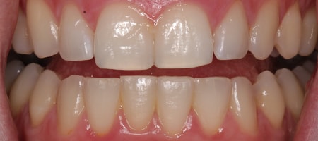 After Invisalign Treatment Smile Rooms Glasgow