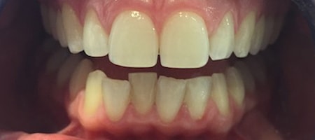 Before Invisalign Treatment Smile Rooms Glasgow