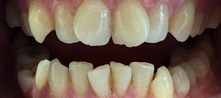 Before Invisalign Treatment Smile Rooms Glasgow