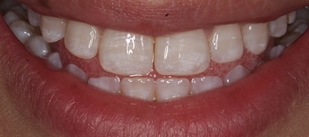 After Invisalign Treatment Smile Rooms Glasgow