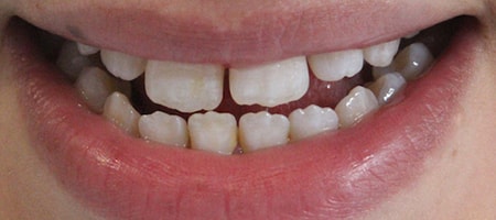 Before Invisalign Treatment Smile Rooms Glasgow