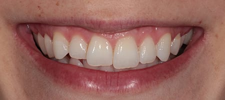 Before & after cosmetic bonding